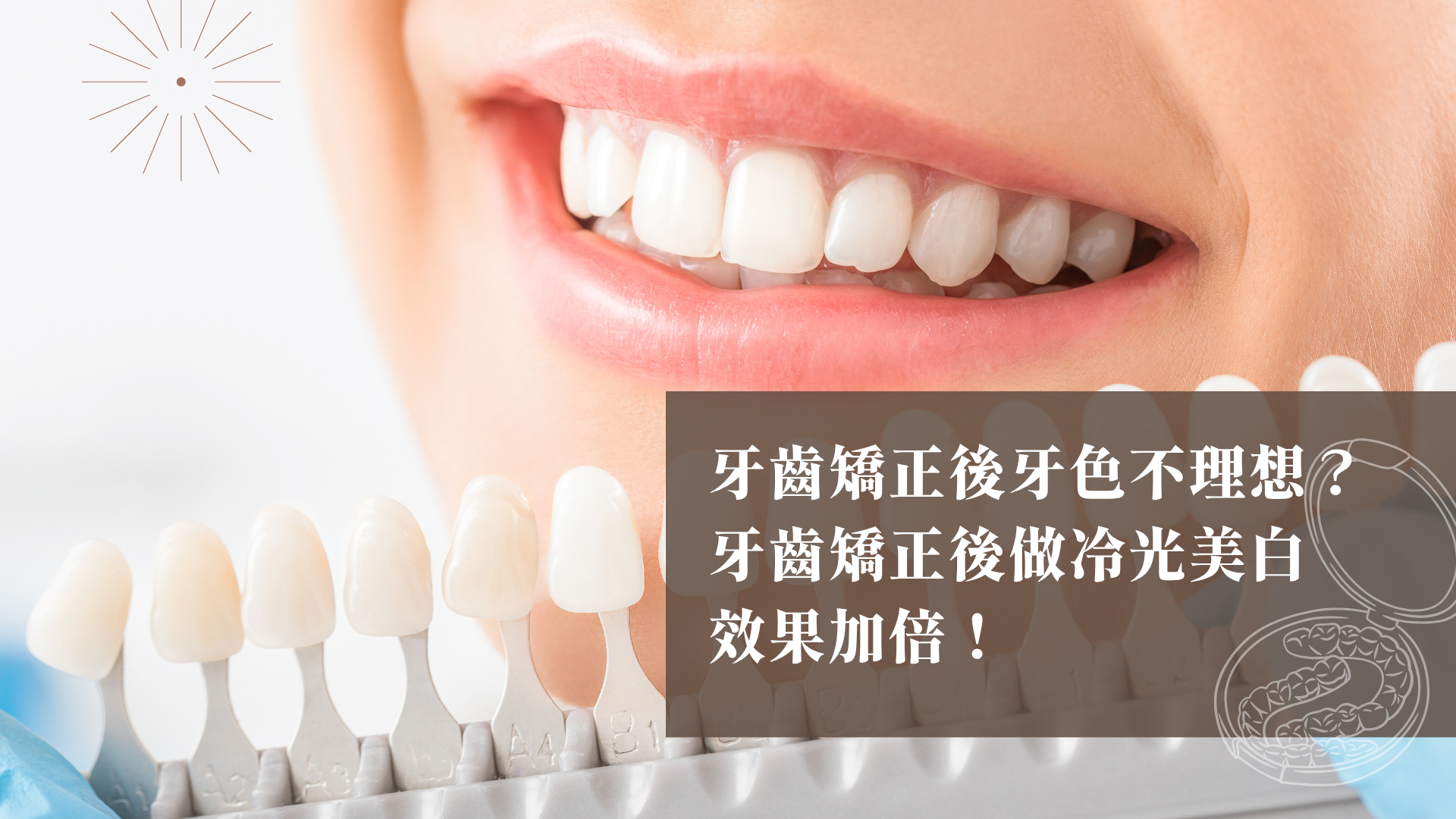 牙齒矯正後牙色不理想？牙齒矯正後做冷光美白效果加倍！